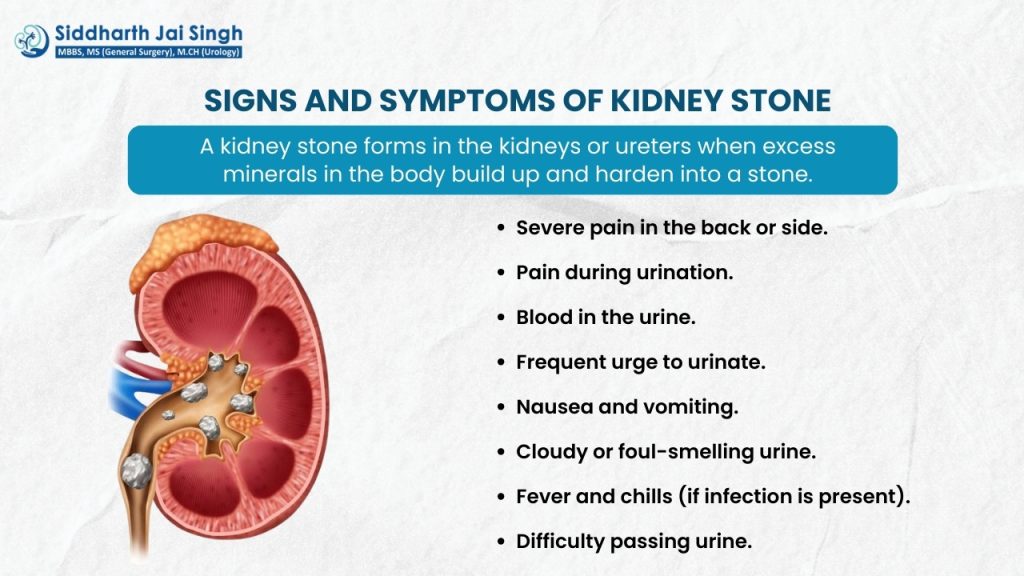 sign and symptons of kidney stone