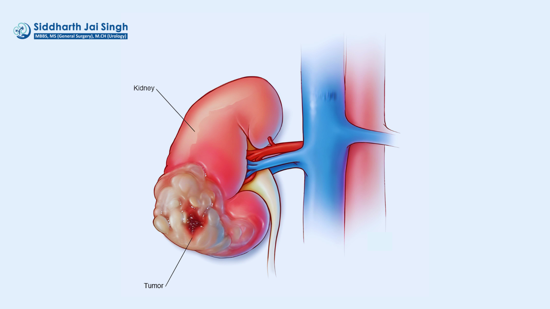 kidney cancer